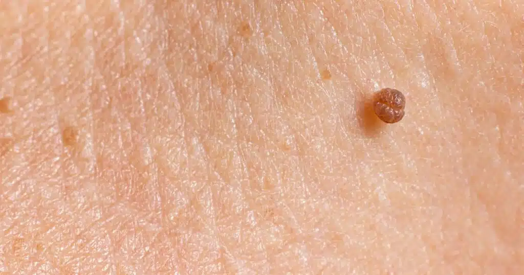 Are benign tumors harmful